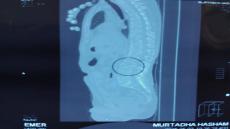 مستشفى الزهراني الجراحي : إجراء عملية جراحه دقيقه المعزز